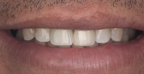 After image of veneers