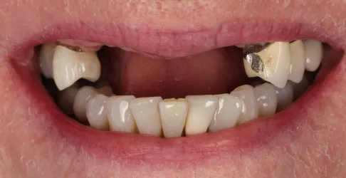 Before image of dental bonding